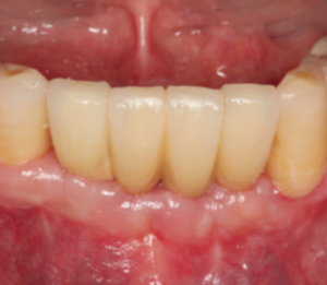 multiple-teeth-after