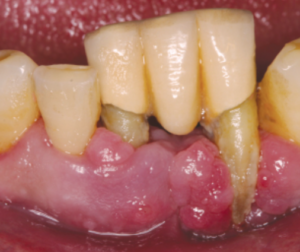 multiple-teeth-before