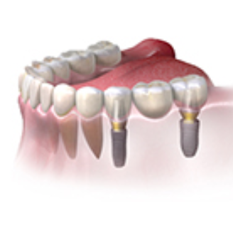 multiple-teeth-diagram